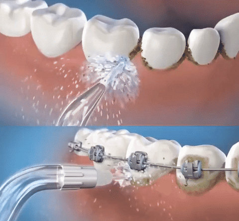 IRRIGADOR DENTAL Y BUCAL
